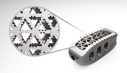 金属AM技術を用いた脊椎治療向けインプラントの開発で患者の負担削減を期待